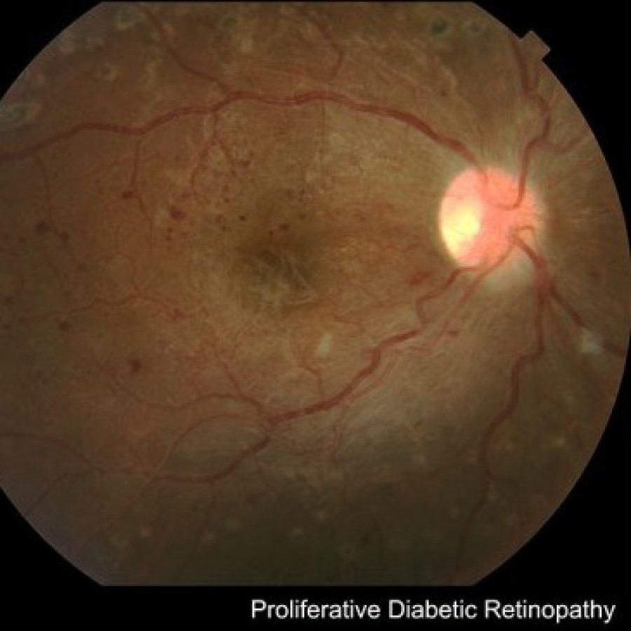 Diabetic Retinopathy