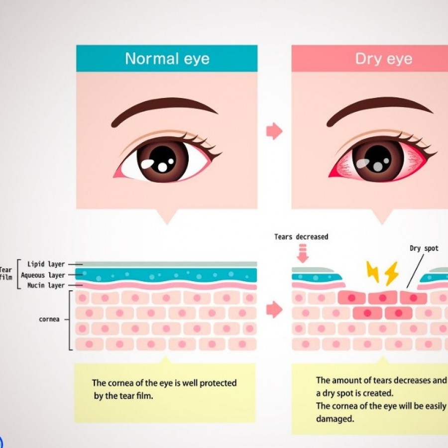Dry Eye Syndrome in NYC