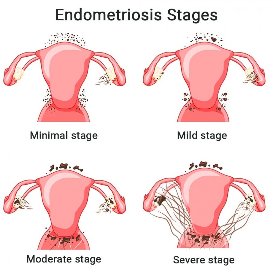 Endometriosis Specialist