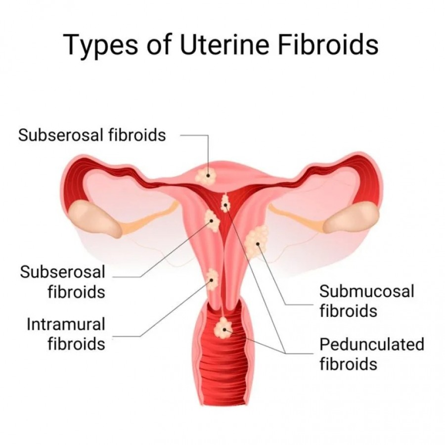 Uterine Fibroid Treatment