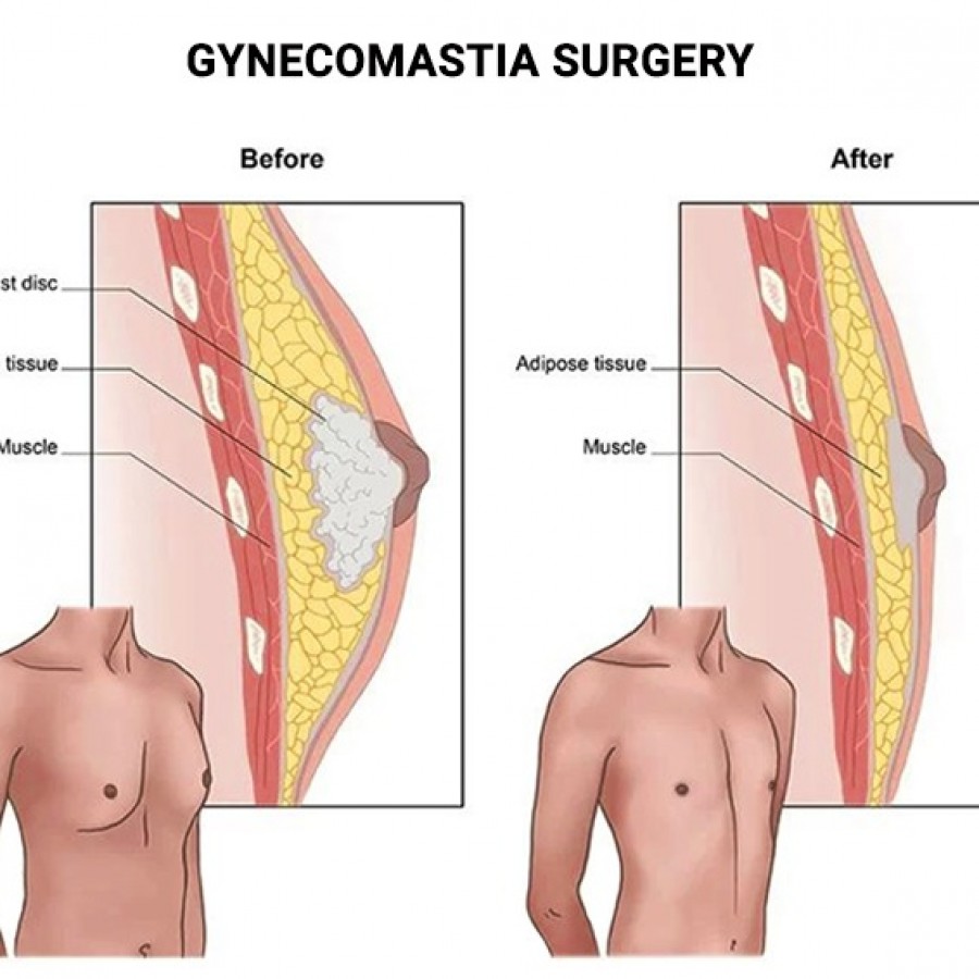 Gynecomastia Surgery 