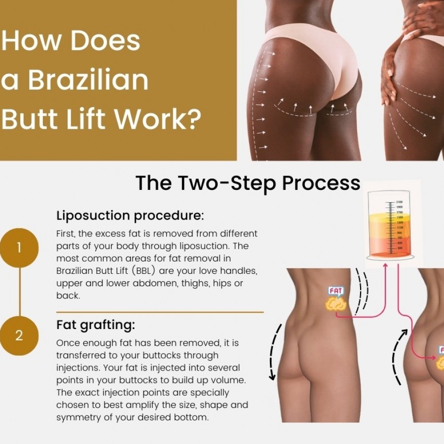 Brazilian Butt Lift Near Me in NYC