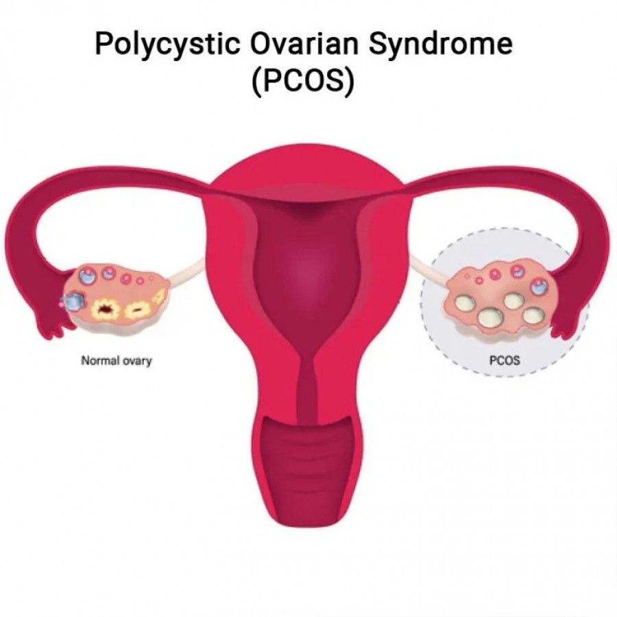 Polycystic Ovarian Syndrome (PCOS) Specialist