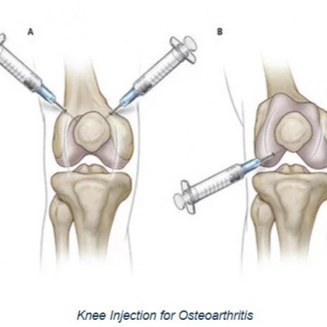Knee Injections for Osteoarthritis in NYC