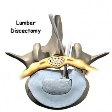 Lumbar Discectomy Surgery in NYC