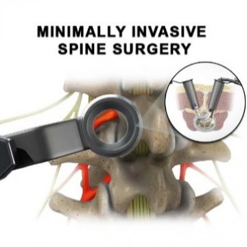 Minimally Invasive Spine Surgery in NYC