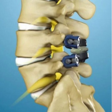 Spinal Stenosis Surgery in NYC