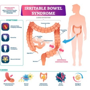 Signs of irritable bowel syndrome