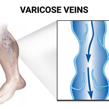 Varicose Veins Removal Doctor in Brooklyn