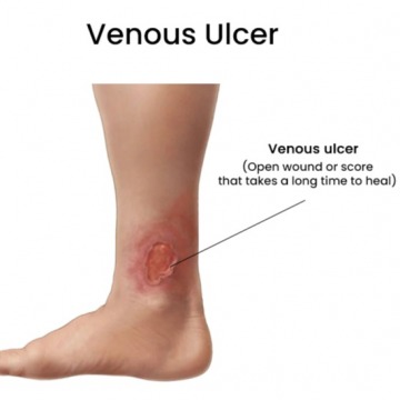 Venous Ulcers Treatment in Brooklyn, New York