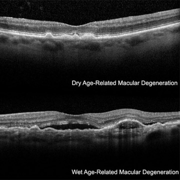 Macular Hole Surgery in NYC
