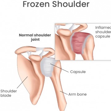 Frozen Shoulder 