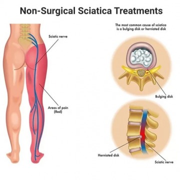The Best Sciatica Relief in NYC and NJ