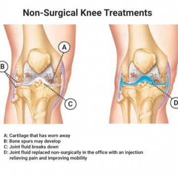 Knee Pain Doctor Near Me: Find Relief at New York Pain Care
