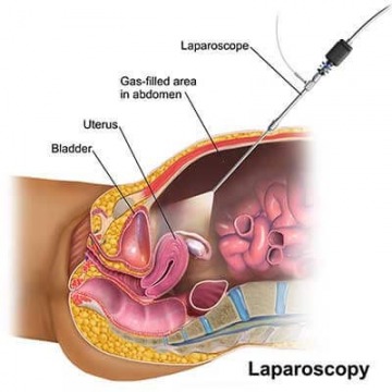 Laparoscopy in Brooklyn Heights, NYC