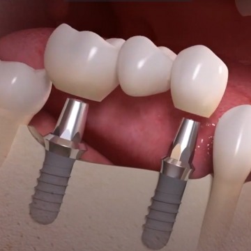 Dental Implants in One Hour in NYC