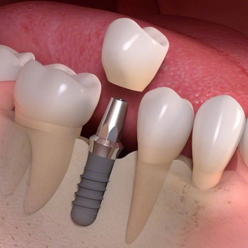 Single Tooth Implants NYC