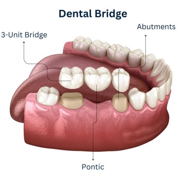 Dental Bridges in Brooklyn, NY