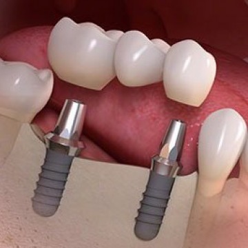 Dental Implants in the Bronx, NY
