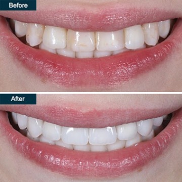 Porcelain Dental Veneers
