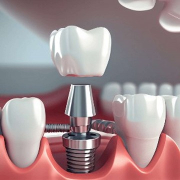 Dental Implants in Brooklyn, NY