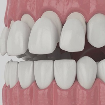 Dental Veneers Stamford, CT