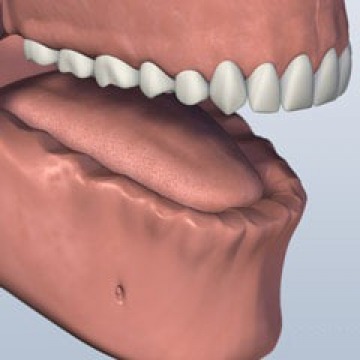 FULL MOUTH DENTAL IMPLANTS