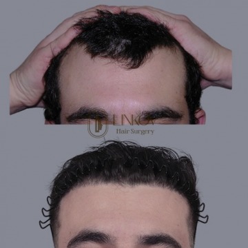 NYC Male Hair Loss Treatments