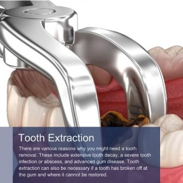 Tooth Extraction in NYC
