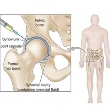 Hip Injury Treatment Specialists in New Jersey