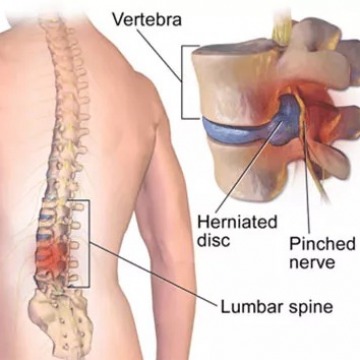 Back Injury Treatment in NJ