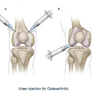 Knee Injections for Osteoarthritis in NYC