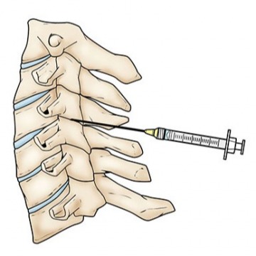 Lumbar Epidural Steroid Injection in NYC