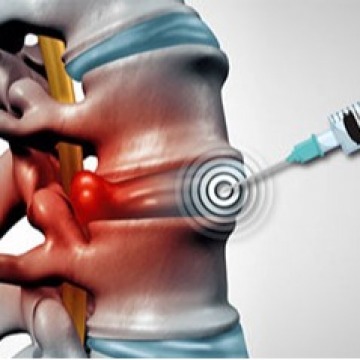 Cervical Epidural Steroid Injection in NYC