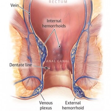 Hemorrhoid Treatment Specialist in New York