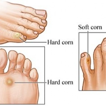 Corn removal surgery NYC