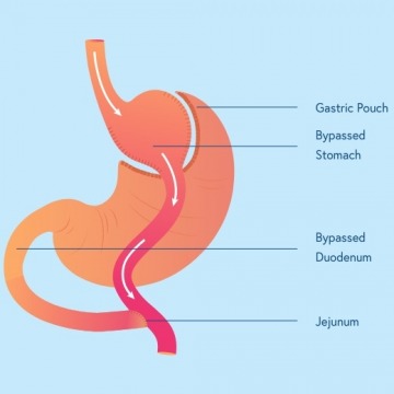 Weight Loss Surgery in New Jersey