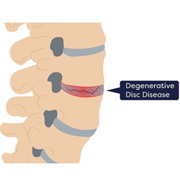 Artificial Disc Replacement Surgery NJ