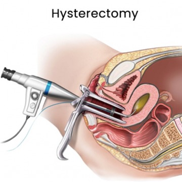 Uterine Fibroid Removal Surgery in Downtown Brooklyn, NY