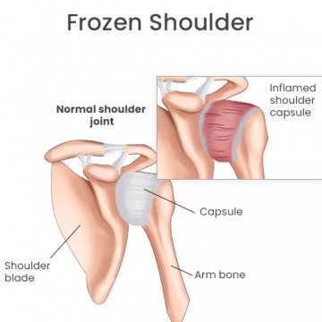 Frozen Shoulder in Paramus, NJ