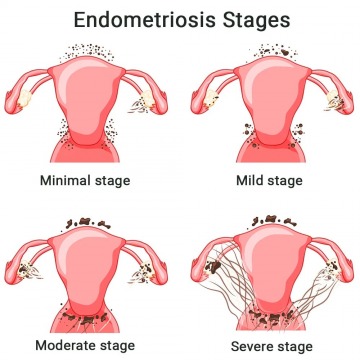 Endometriosis Specialist